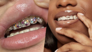 Lire la suite à propos de l’article La beauté du sourire : esthétique dentaire, strass et appareils dentaires