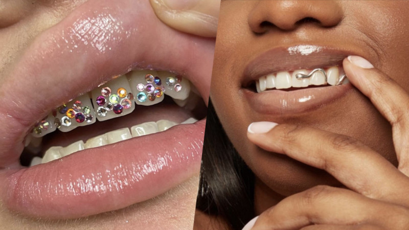 You are currently viewing La beauté du sourire : esthétique dentaire, strass et appareils dentaires